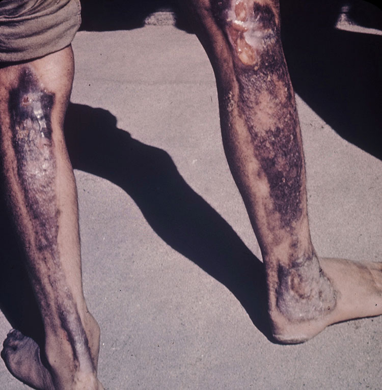 RADIATION EXPOSURE DAMAGE FROM CHERNOBYL DISASTER IN THE FORMER U.S.S.R.