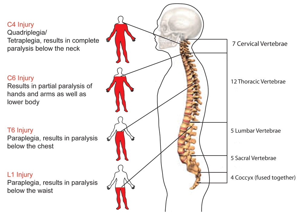 SPINAL CORD INJURY