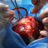 HEART TRANSPLANT SURGERY